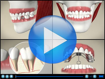 teeth filling videos