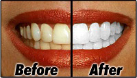 zoom tooth whitening Toronto Markham 2